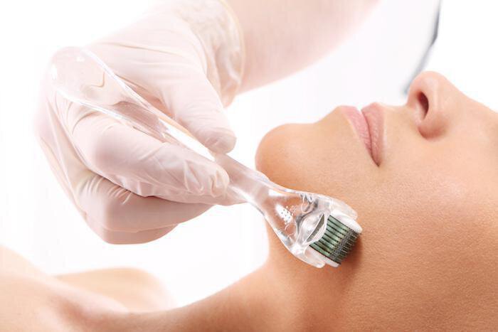 Everything You Need to Know About RF Microneedling 
