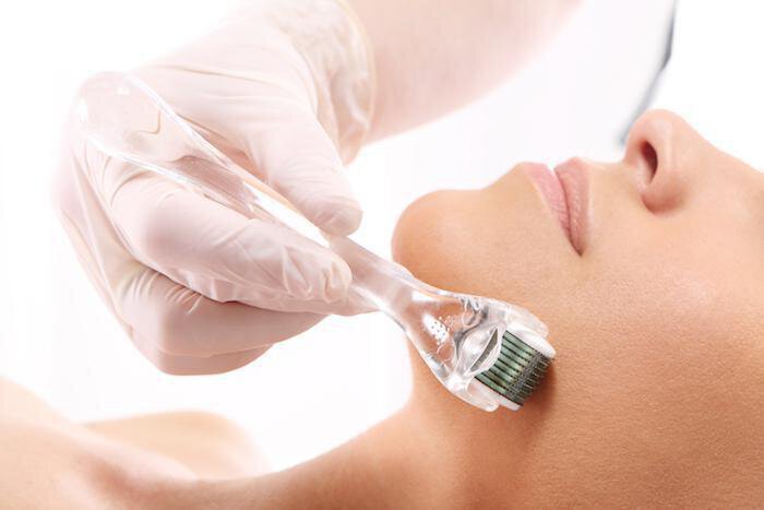 Everything You Need to Know About RF Microneedling