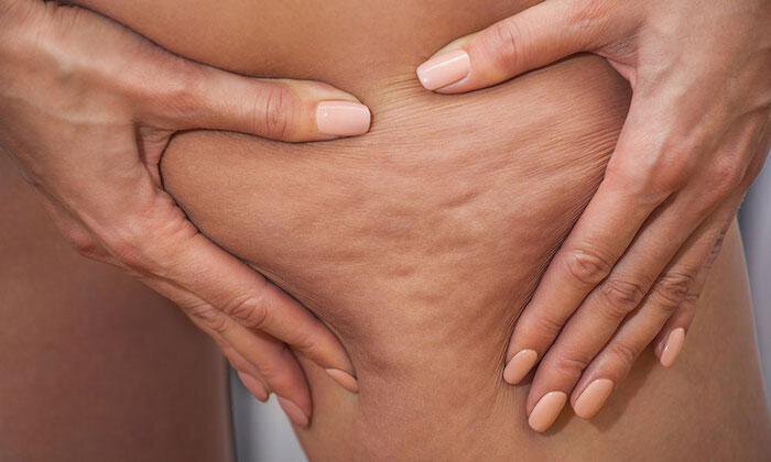 Bothered by Cellulite? Consider Z Wave®