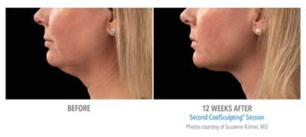 CoolSculpting Before & After Image