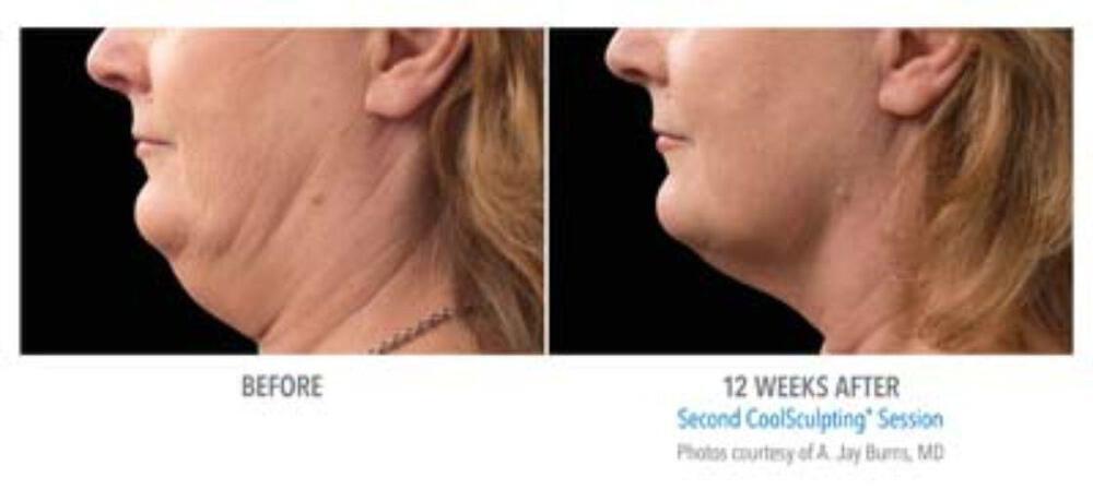 CoolSculpting Before & After Image