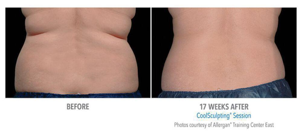 CoolSculpting Before & After Image