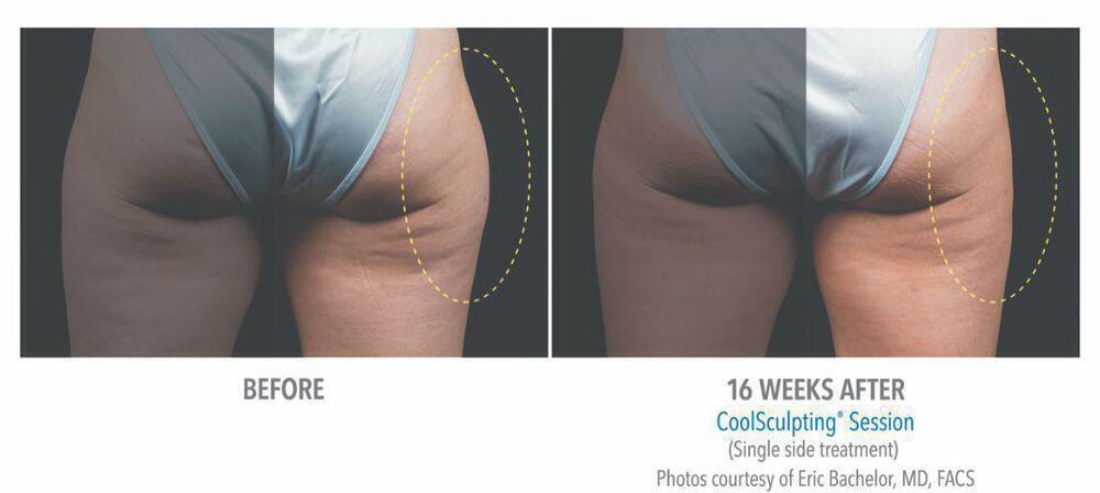 CoolSculpting Before & After Image