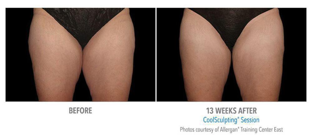 CoolSculpting Before & After Image