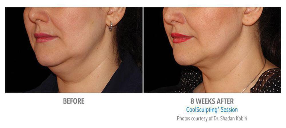 CoolSculpting Before & After Image