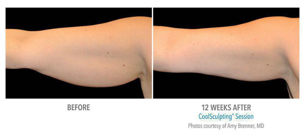 CoolSculpting Before & After Image