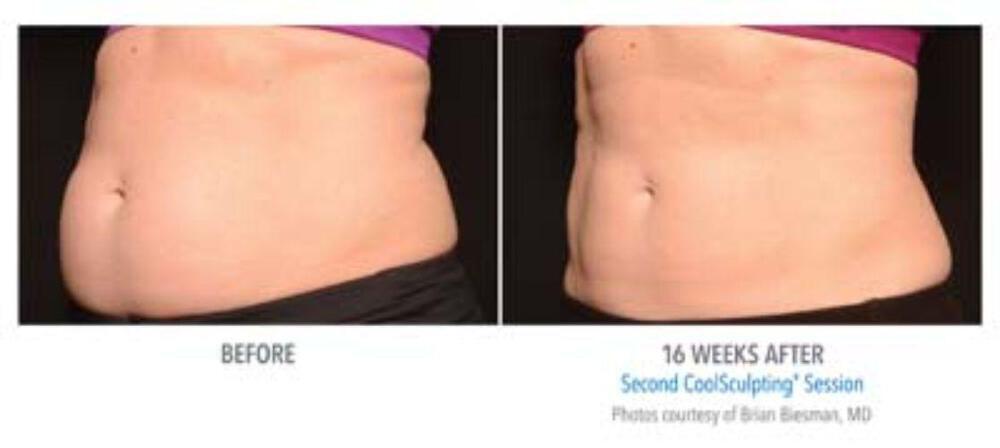 CoolSculpting Before & After Image