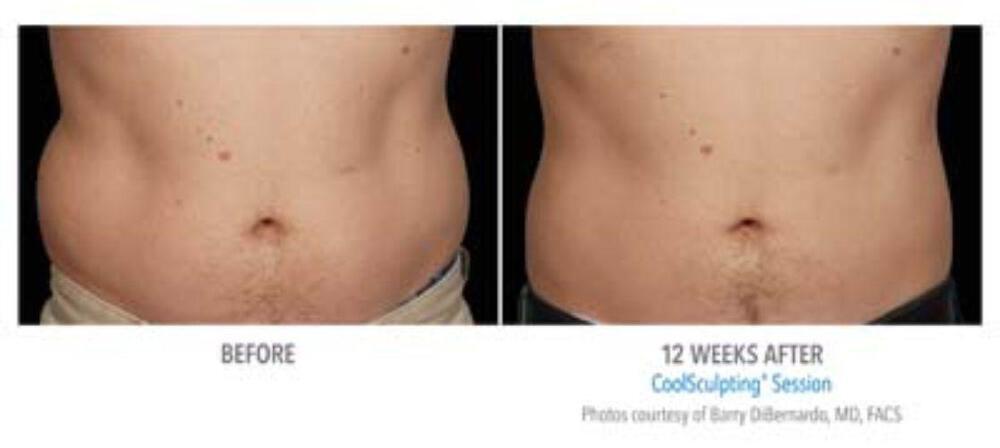 CoolSculpting Before & After Image