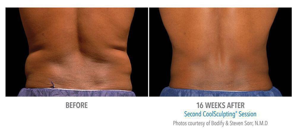 CoolSculpting Before & After Image