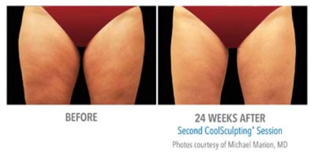 CoolSculpting Before & After Image