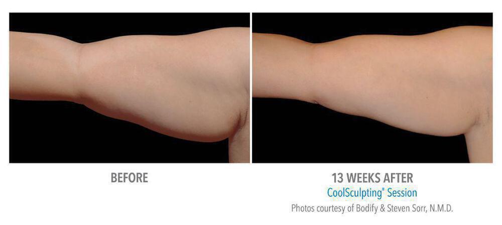 CoolSculpting Before & After Image