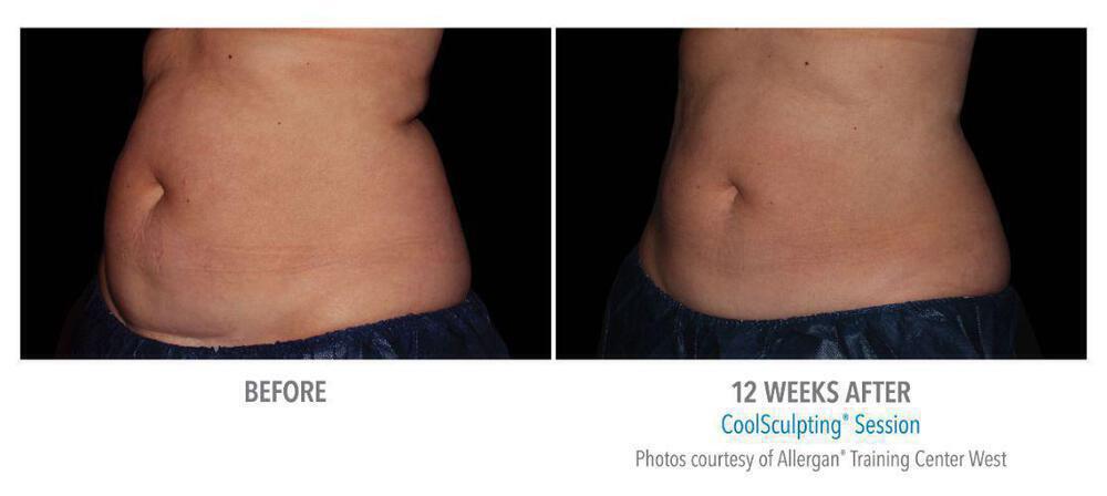 CoolSculpting Before & After Image