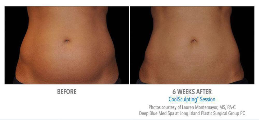 CoolSculpting Before & After Image