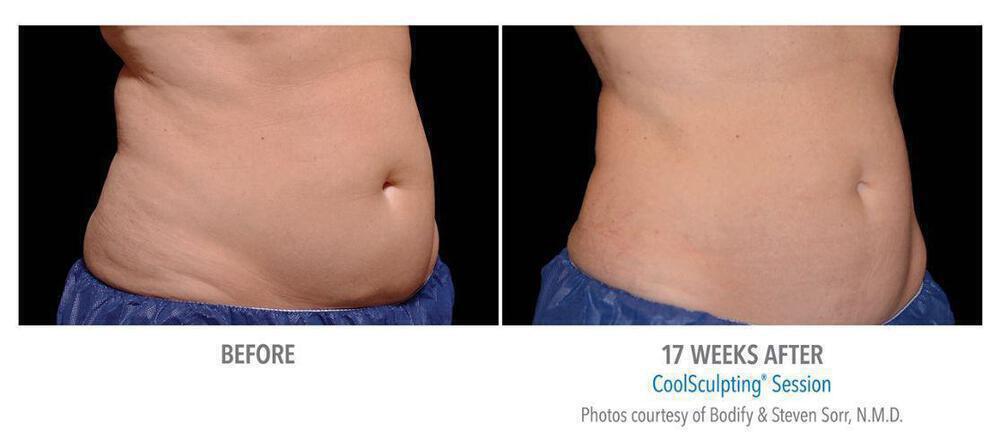 CoolSculpting Before & After Image