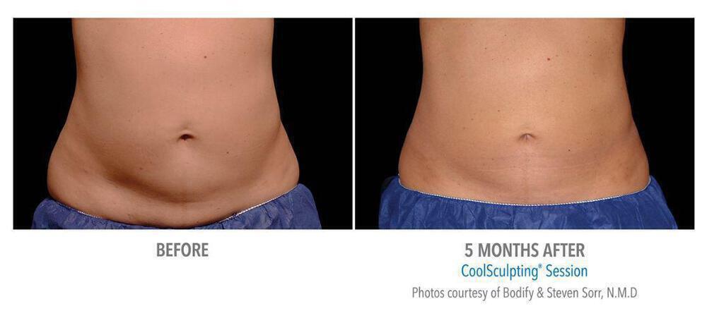 CoolSculpting Before & After Image