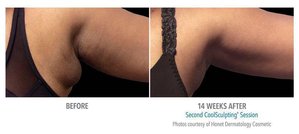 CoolSculpting Before & After Image