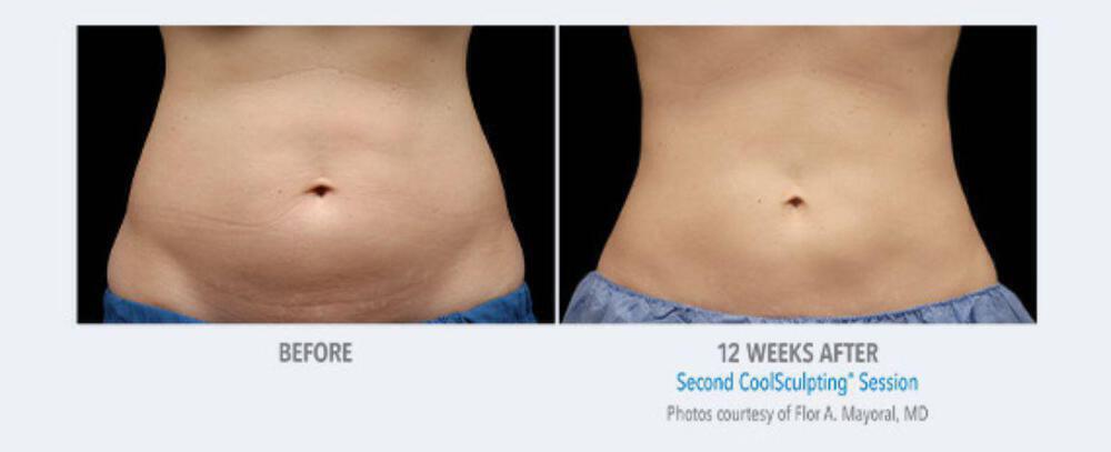 CoolSculpting Before & After Image