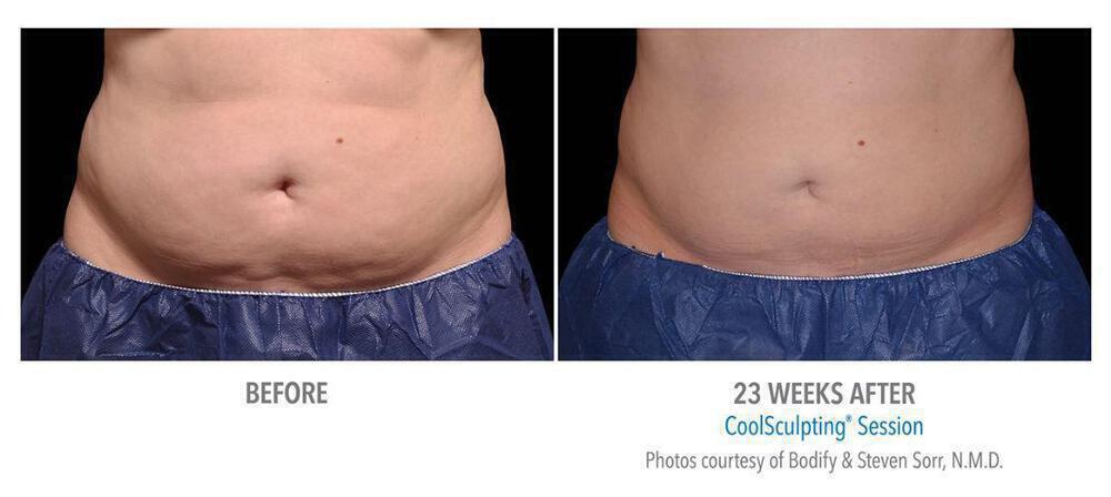 CoolSculpting Before & After Image