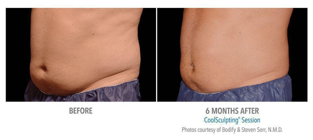 CoolSculpting Before & After Image