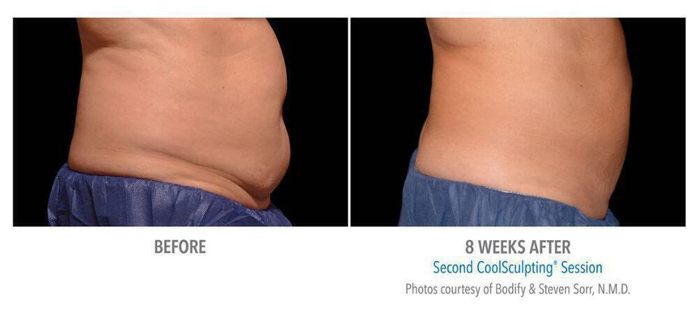 CoolSculpting Before & After Image