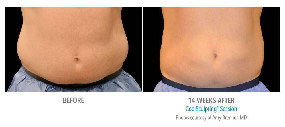 CoolSculpting Before & After Image