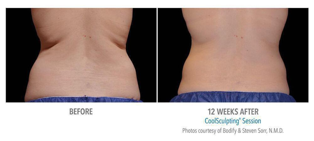 CoolSculpting Before & After Image