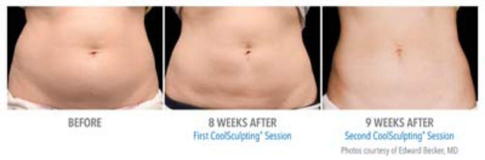 CoolSculpting Before & After Image