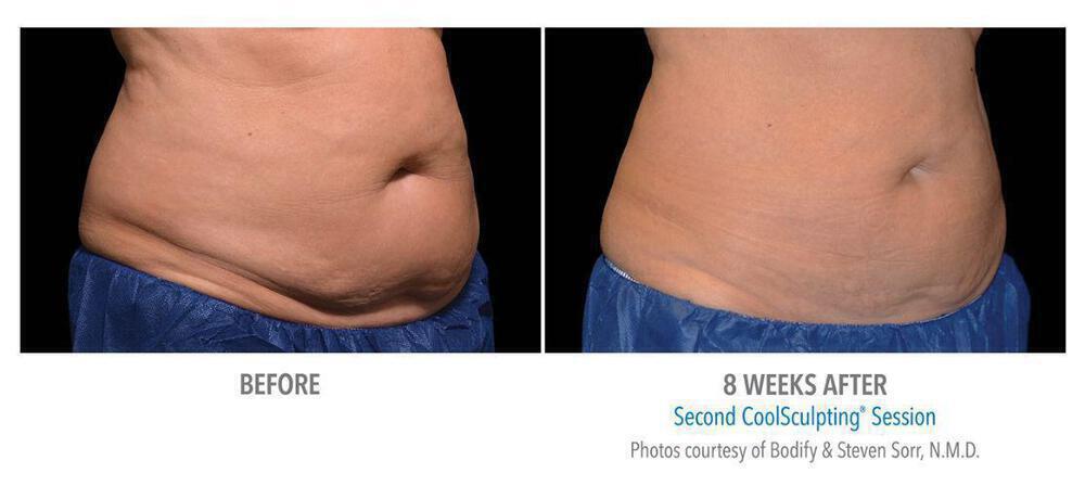 CoolSculpting Before & After Image