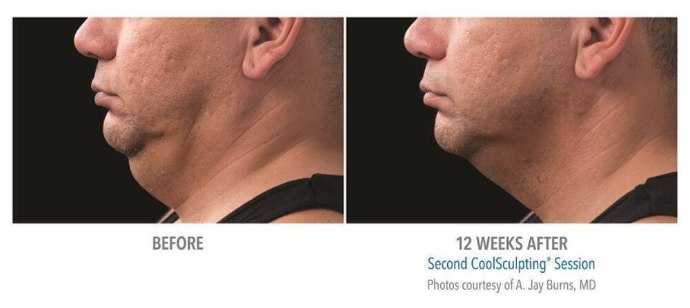 CoolSculpting Before & After Image