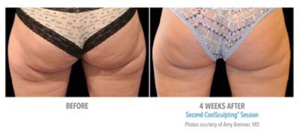 CoolSculpting Before & After Image