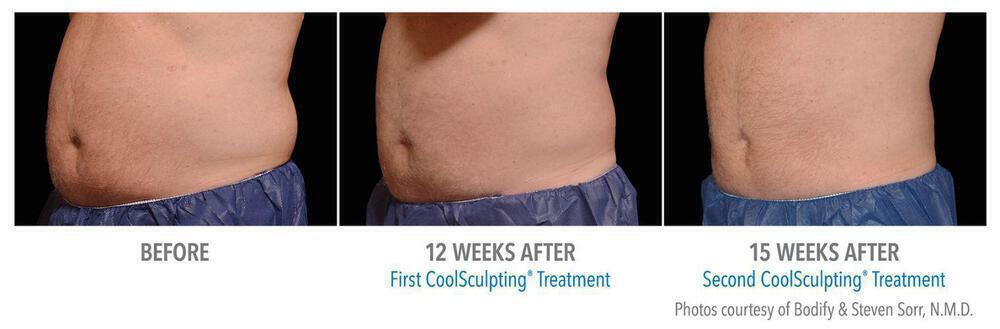 CoolSculpting Before & After Image