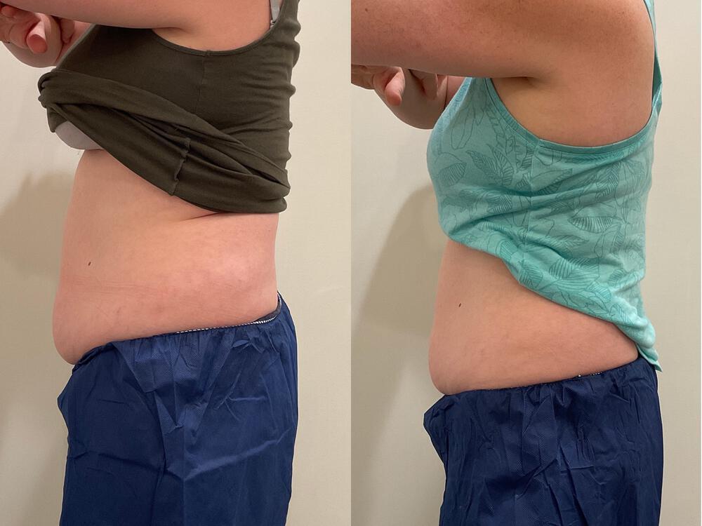 CoolSculpting Before & After Image