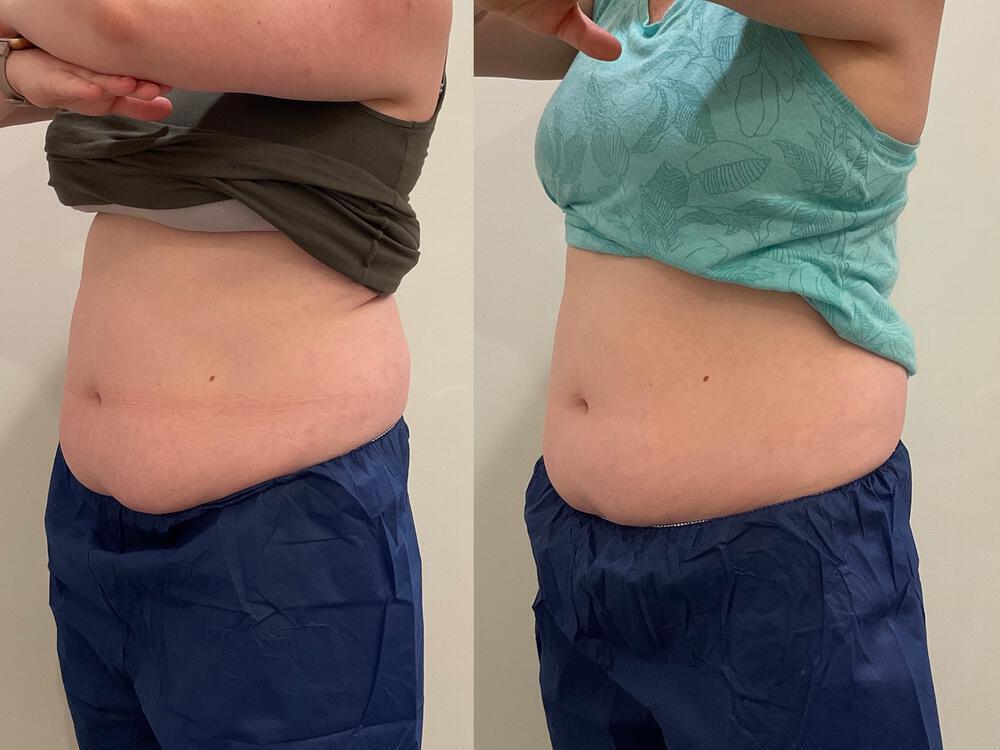 CoolSculpting Before & After Image