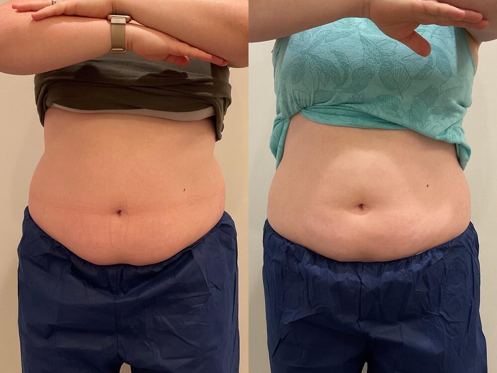 CoolSculpting Before & After Image