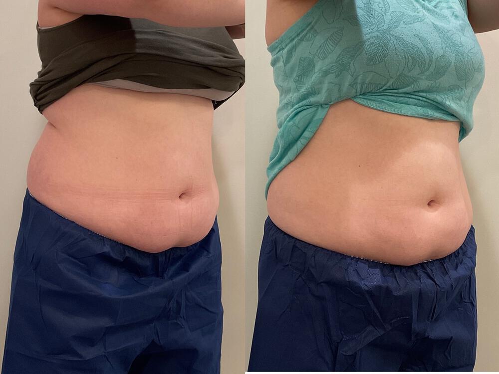 CoolSculpting Before & After Image