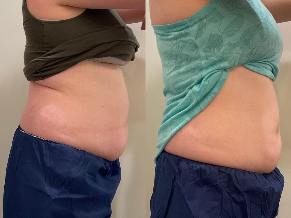 CoolSculpting Before & After Image