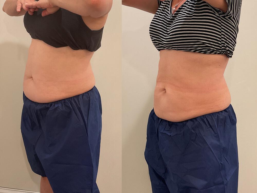 CoolSculpting Before & After Image