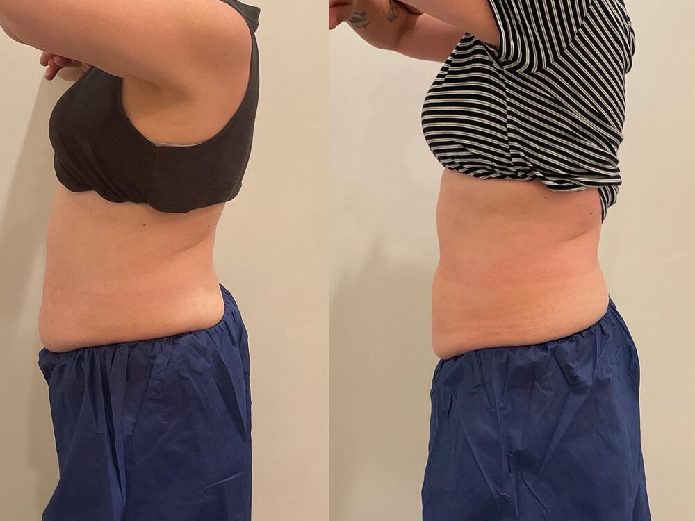 CoolSculpting Before & After Image