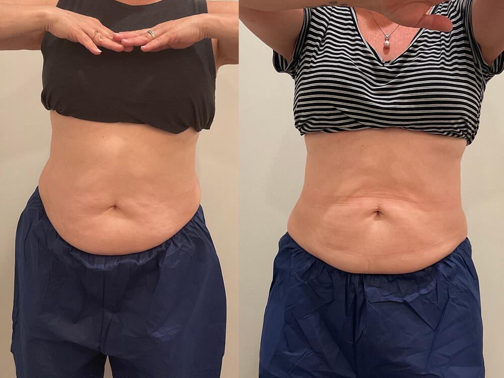 CoolSculpting Before & After Image