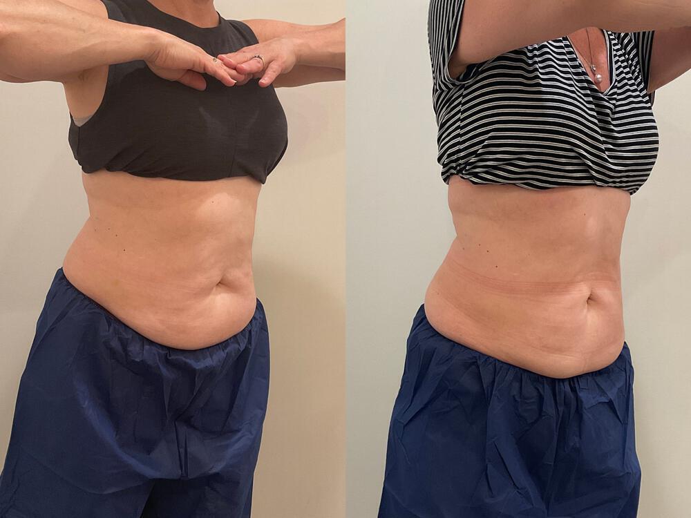 CoolSculpting Before & After Image