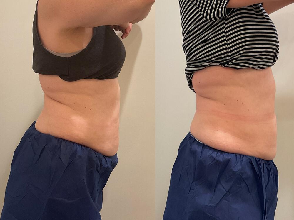 CoolSculpting Before & After Image