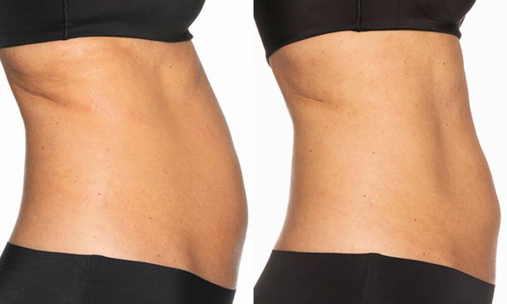 CoolSculpting Before & After Image