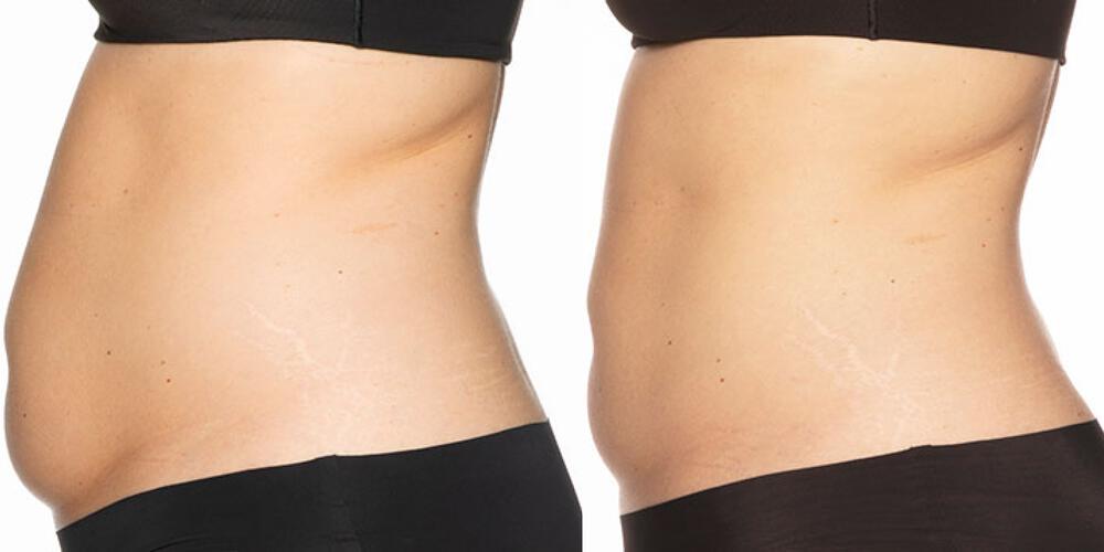 CoolSculpting Before & After Image