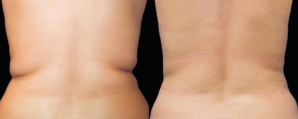 CoolSculpting Before & After Image