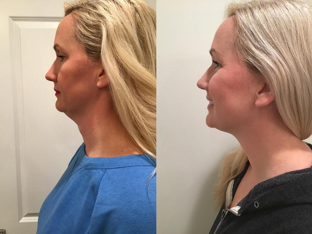 CoolSculpting Before & After Image