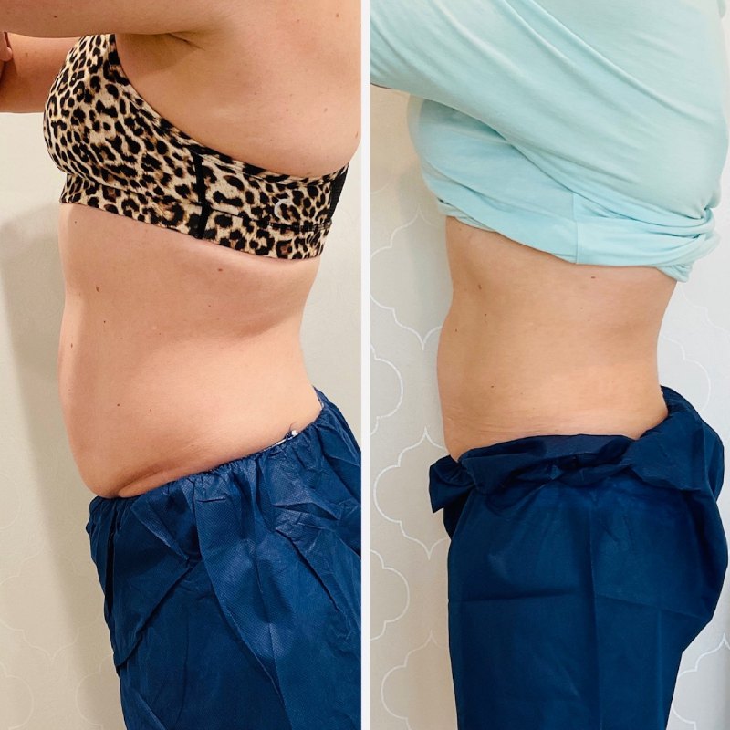 CoolSculpting Before & After Image