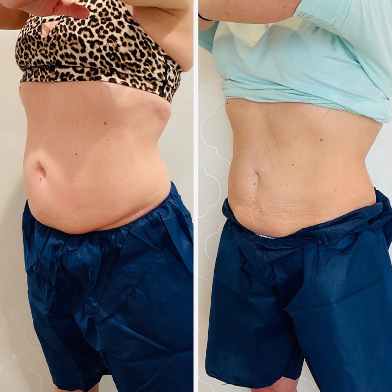 CoolSculpting Before & After Image