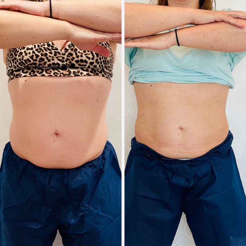 CoolSculpting Before & After Image