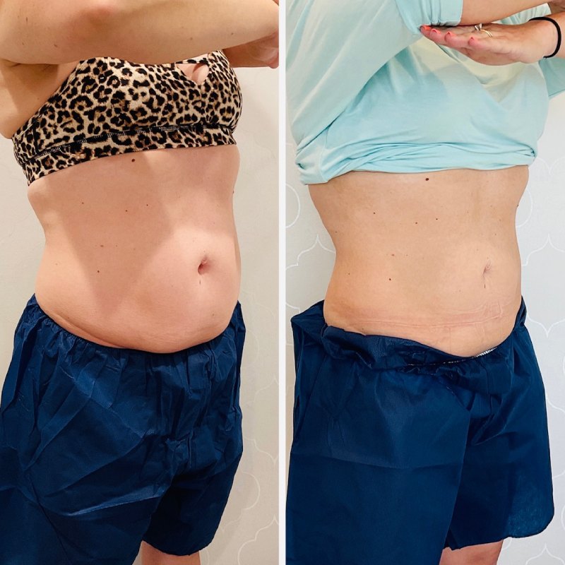 CoolSculpting Before & After Image