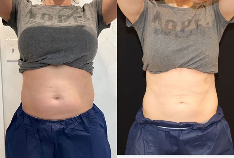 CoolSculpting Before & After Image